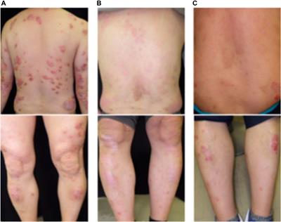 Uveitis in a psoriasis vulgaris patient receiving deucravacitinib: a case report